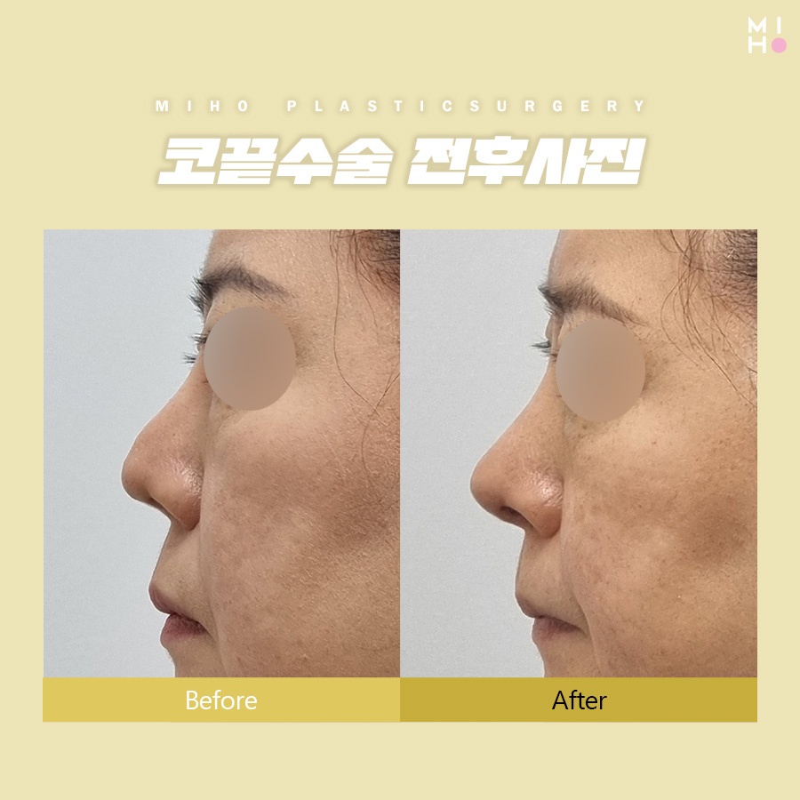 Considering Harmony in Tip Rhinoplasty image 8