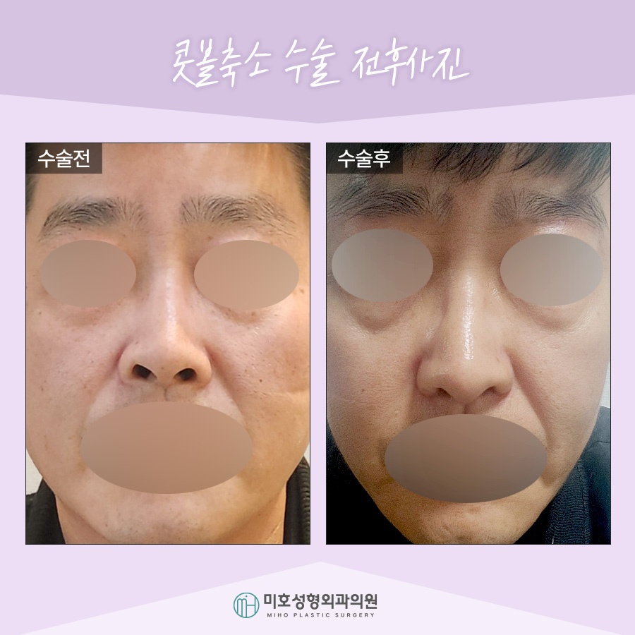 Nasal Alar Reduction in a Natural Direction image 9
