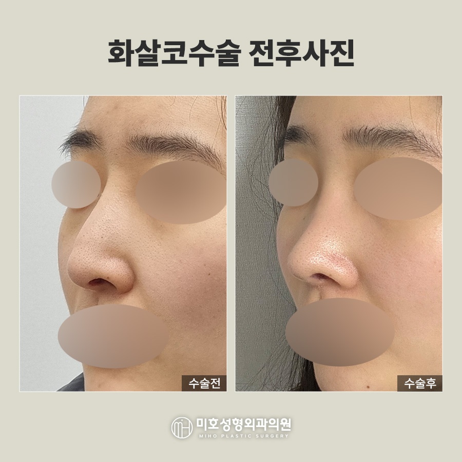 화살코 처진 코끝 교정으로 세련된 인상 만들기 관련 이미지 7