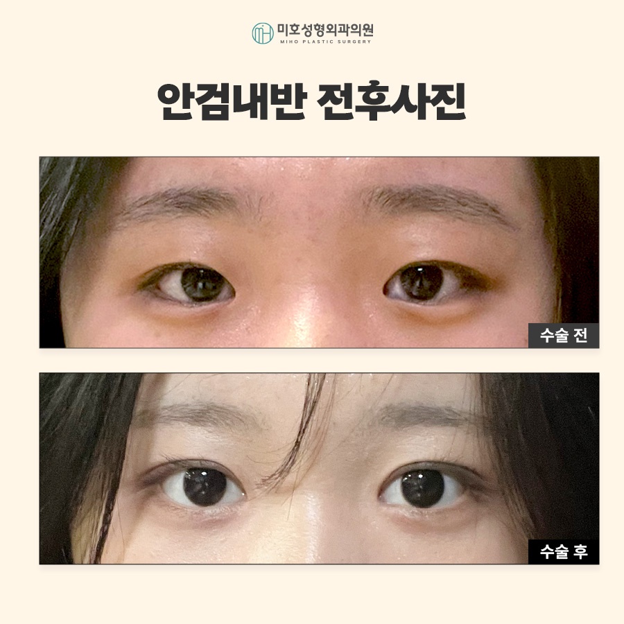안검내반수술 눈물과 자극이 반복된다면 관련 이미지 6