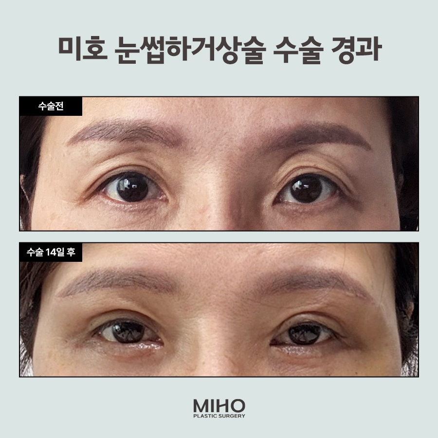 Sub-Brow Lift Scar, Cost, Recovery Process, Information, and Review image 6
