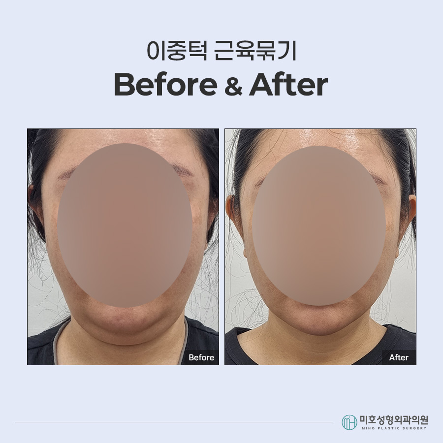 이중턱묶기란? 지방흡입과 차이부터 적합한 경우, 회복 과정까지 관련 이미지 9