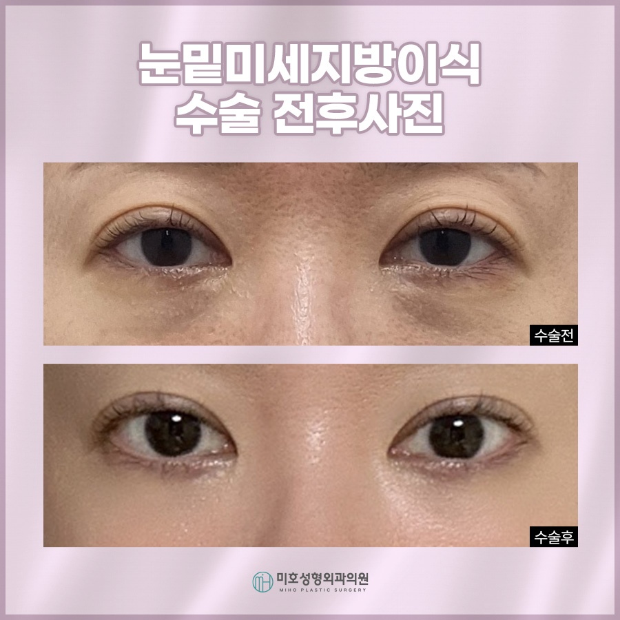 눈밑미세지방이식 올바른 계획으로 관련 이미지 7