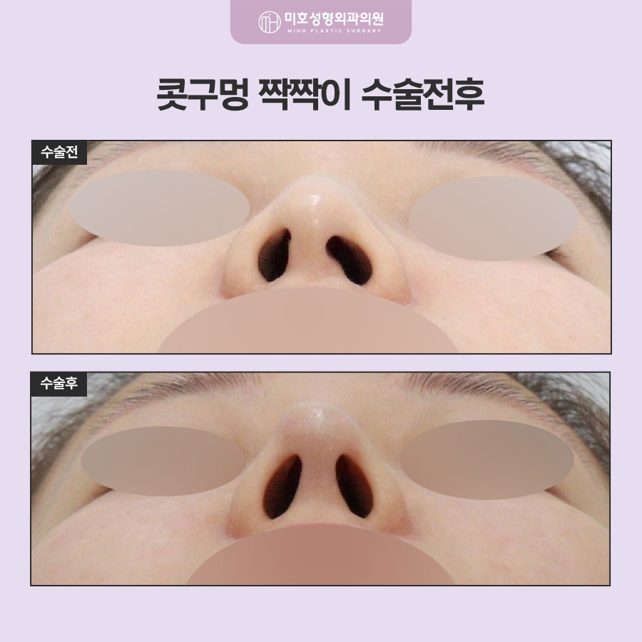 콧구멍짝짝이 원인과 교정 방향 관련 이미지 10