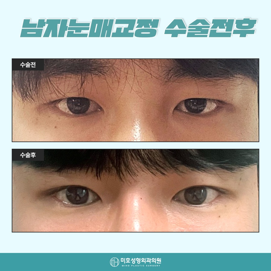 Natural-Looking Male Eye Shape Correction image 9