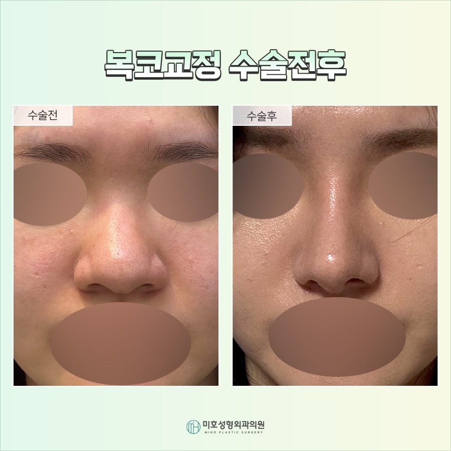 Nose Tip Refinement for a More Defined Impression image 7