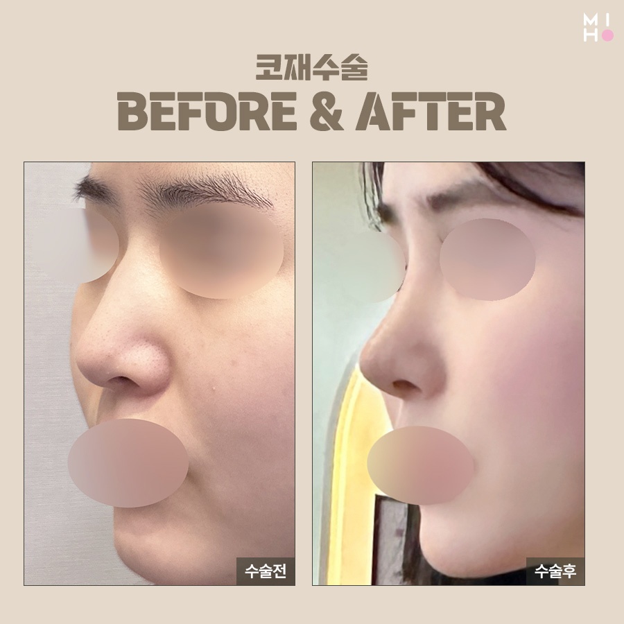 Revision Rhinoplasty Cost: Proceed Carefully, Since This Is a Second Attempt image 9