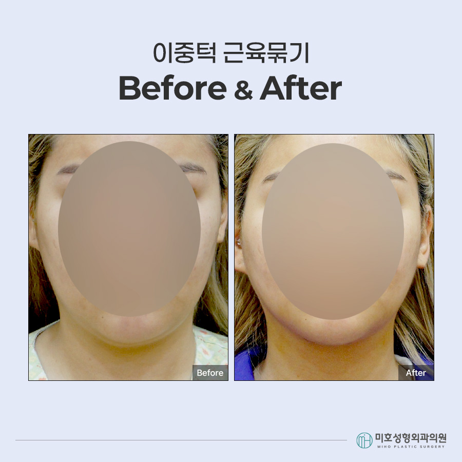 이중턱묶기란? 지방흡입과 차이부터 적합한 경우, 회복 과정까지 관련 이미지 10