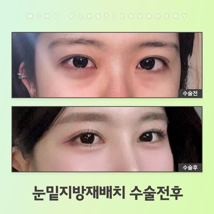 눈밑지방재배치 고민에 맞게 개선하며 관련 이미지 9