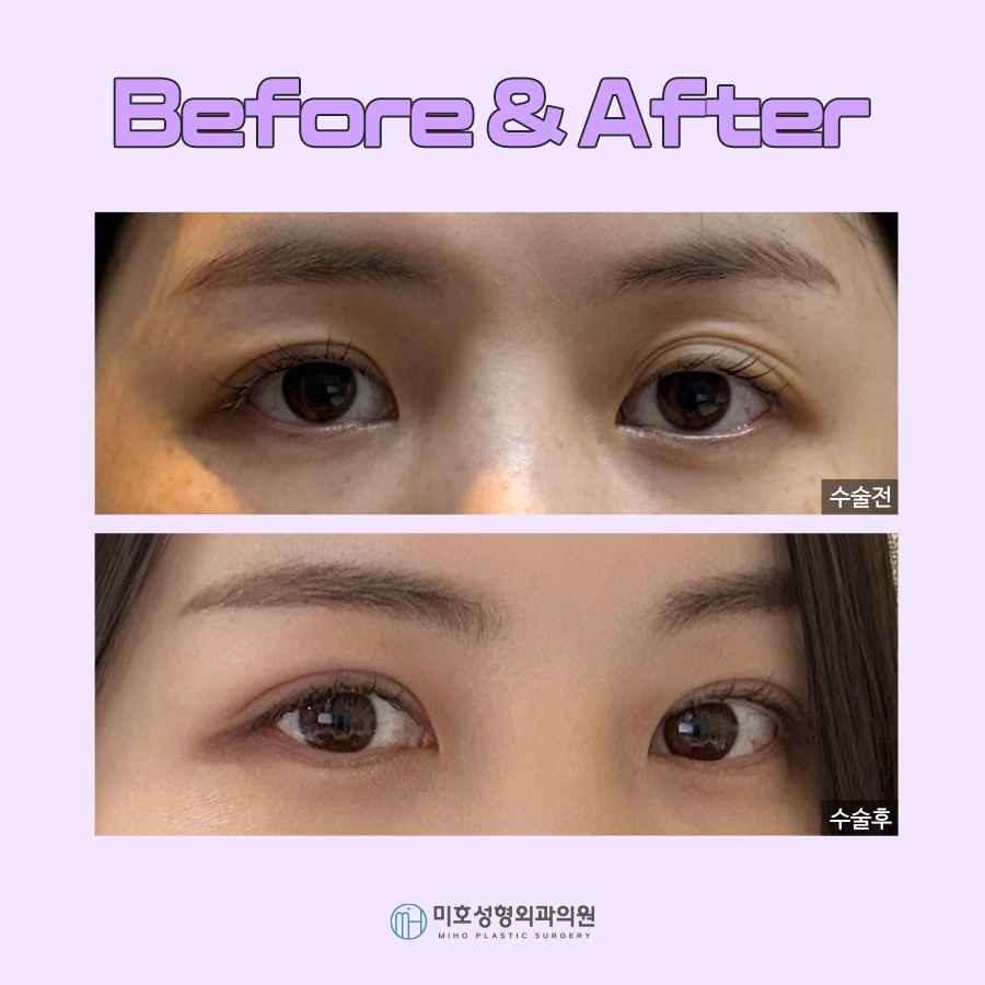 A Clean, Smooth Line for Double Eyelid Folds image 7