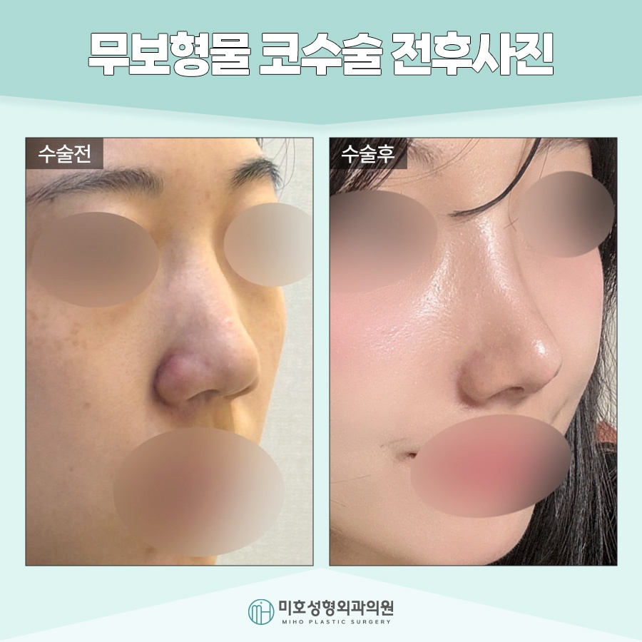 무보형물코수술 자연스러운 라인을 원한다면 관련 이미지 9