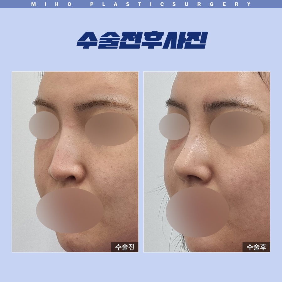 Correcting a Dragon Nose with Nostril-Lowering Surgery image 8