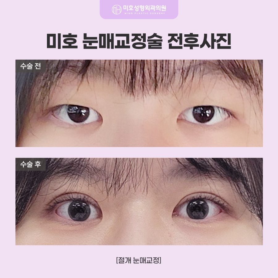 눈매교정술 힘 조절이 필요하다면 관련 이미지 10