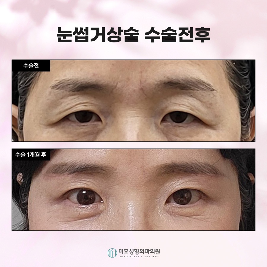 눈썹거상후기 속 주인공이 되는 법 관련 이미지 7