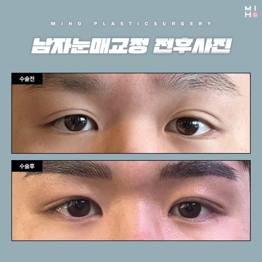 남자눈매교정 무쌍부터 유쌍까지 시원하게 관련 이미지 8