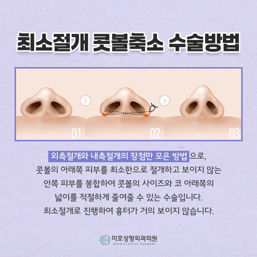 Refining Nostril Reduction in a Sophisticated Way image 6