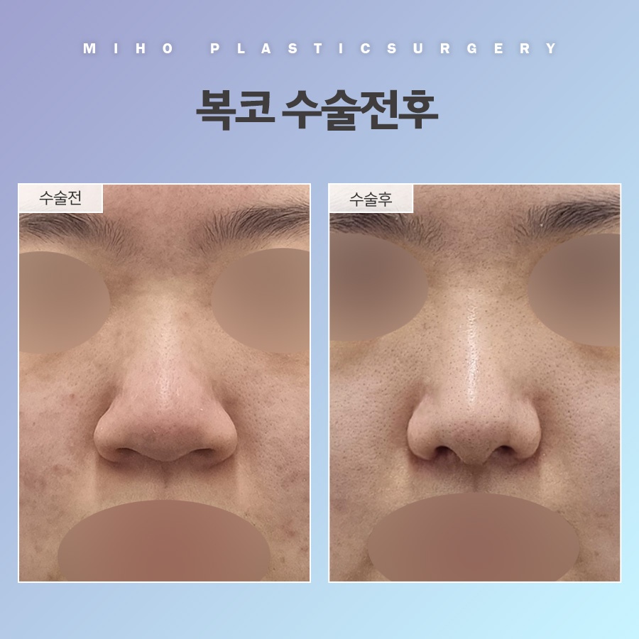 복코 교정 관상까지 좋아지려면 관련 이미지 10
