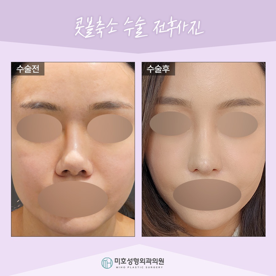 Nasal Alar Reduction in a Natural Direction image 10
