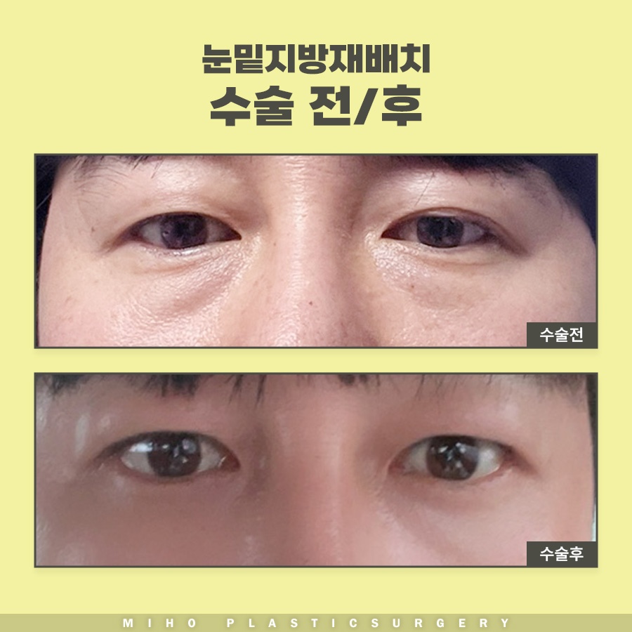 눈밑지방재배치수술비용 내게 맞는 수준은 관련 이미지 10