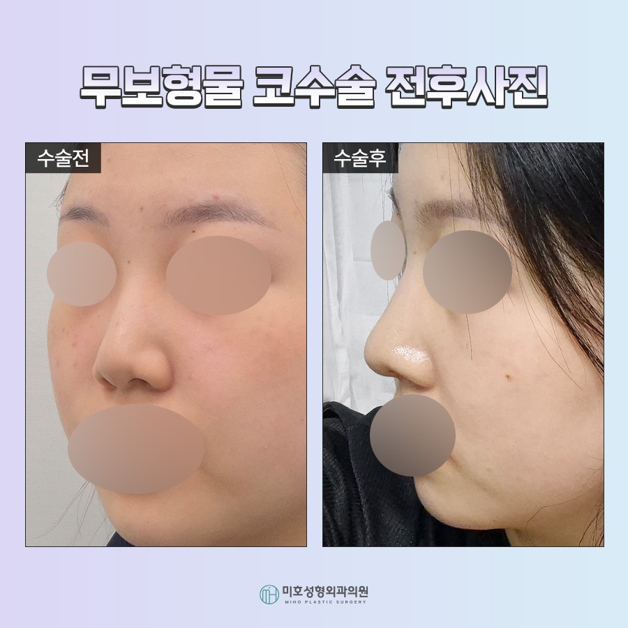 A Natural Nose Using Autologous Tissue: Implant-Free Rhinoplasty image 10