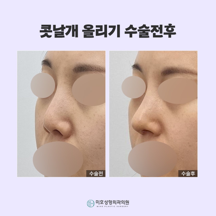 콧날개올리기 비익거상 기준 살펴보고 관련 이미지 8