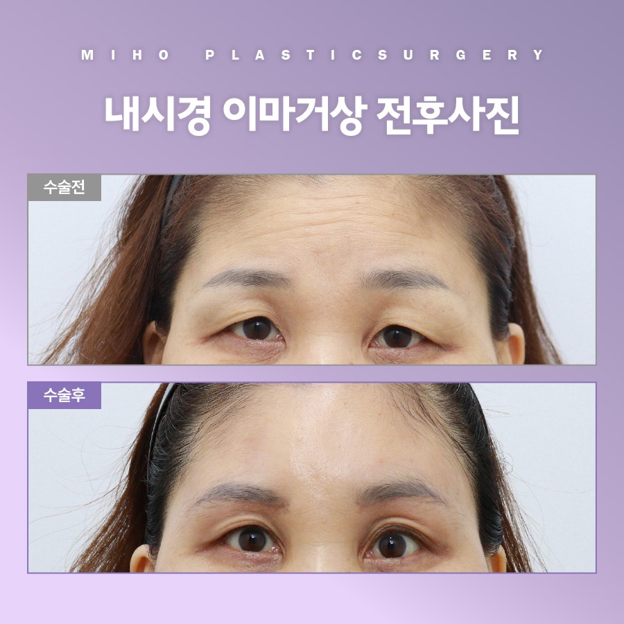 이마거상 비용 및 사후관리 팁 관련 이미지 9