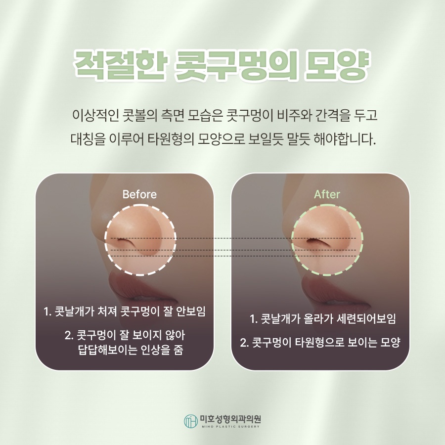 콧날개올리기 처진 코 교정 관련 이미지 4
