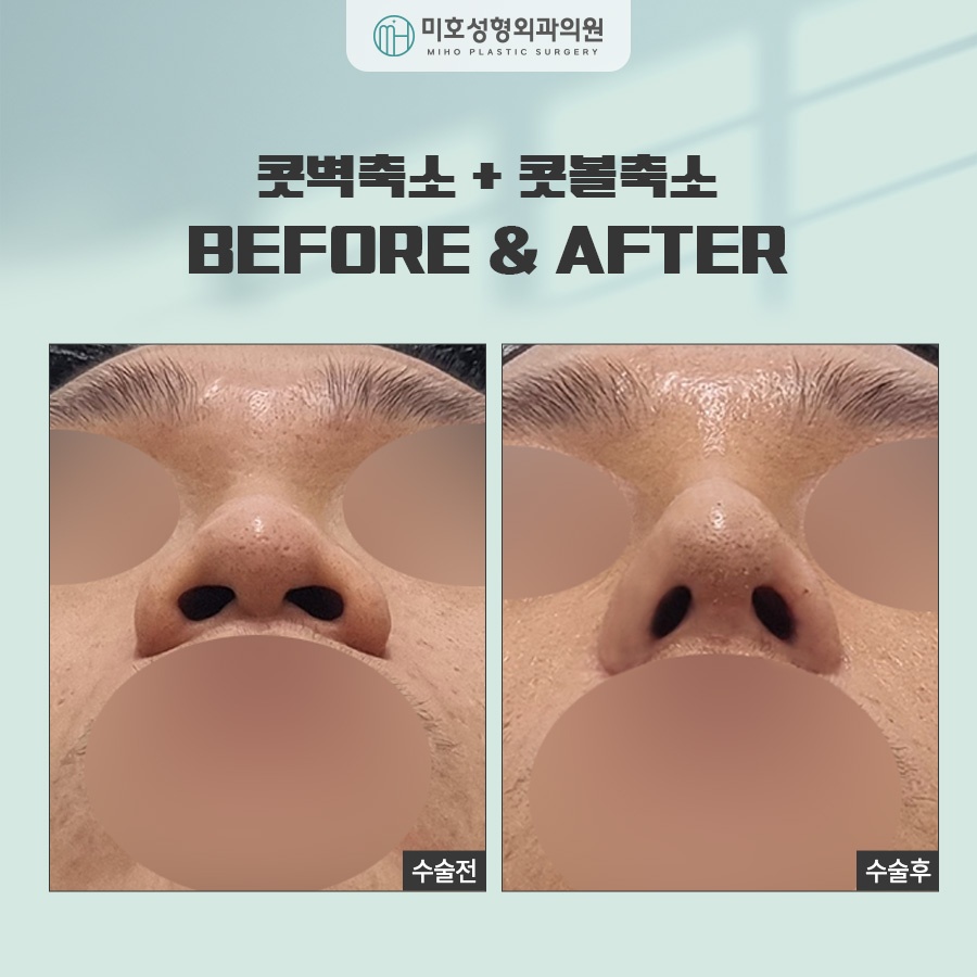 Comprehensive Guide to Alar Reduction Procedure and Aftercare image 7