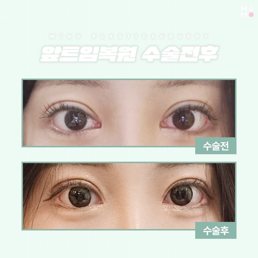 앞트임복원 필요한 상황을 확인하여 관련 이미지 18