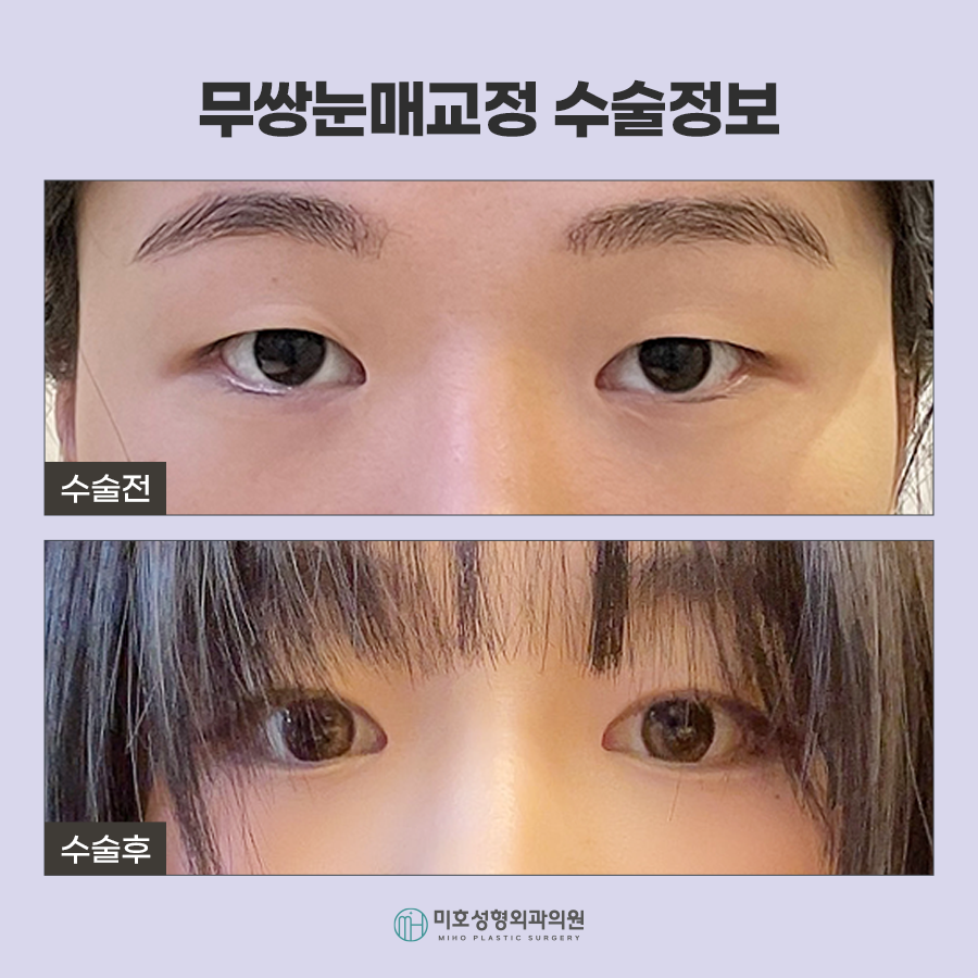 무쌍눈매교정 자연스러운 눈매 완성 관련 이미지 9