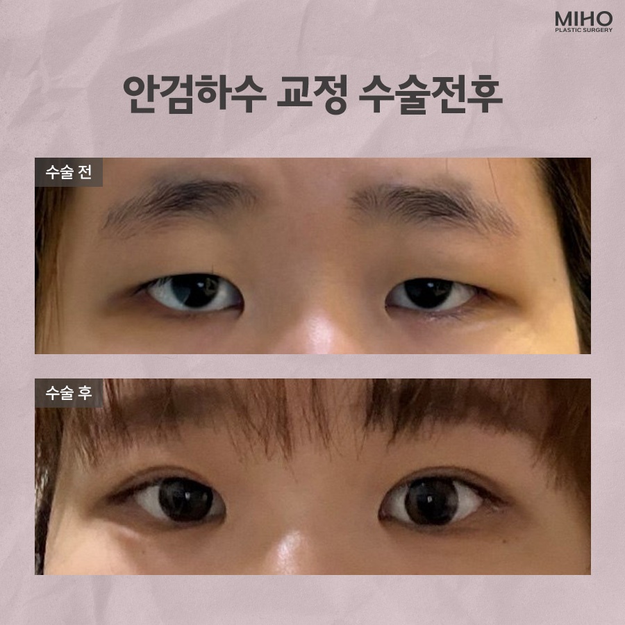 안검하수 발생 요인과 증상에 맞춰 관련 이미지 7