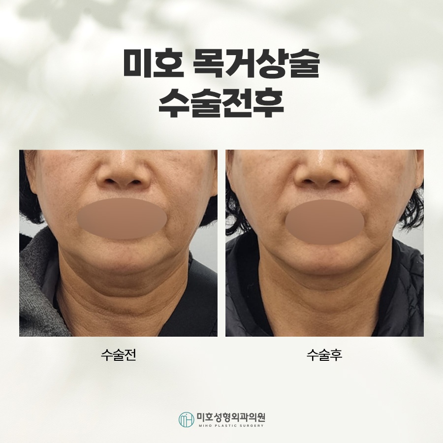 Neck Lift: A Lifting Method to Restore a Sagging Neckline image 9
