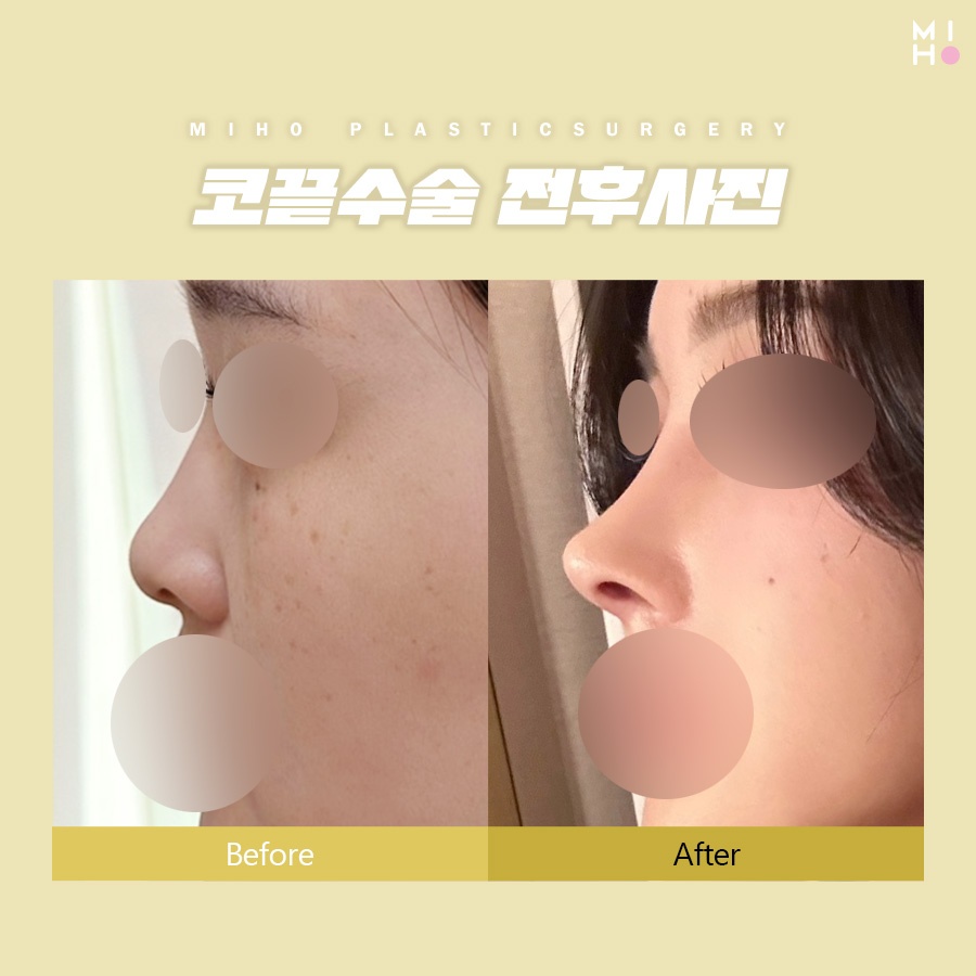Considering Harmony in Tip Rhinoplasty image 9