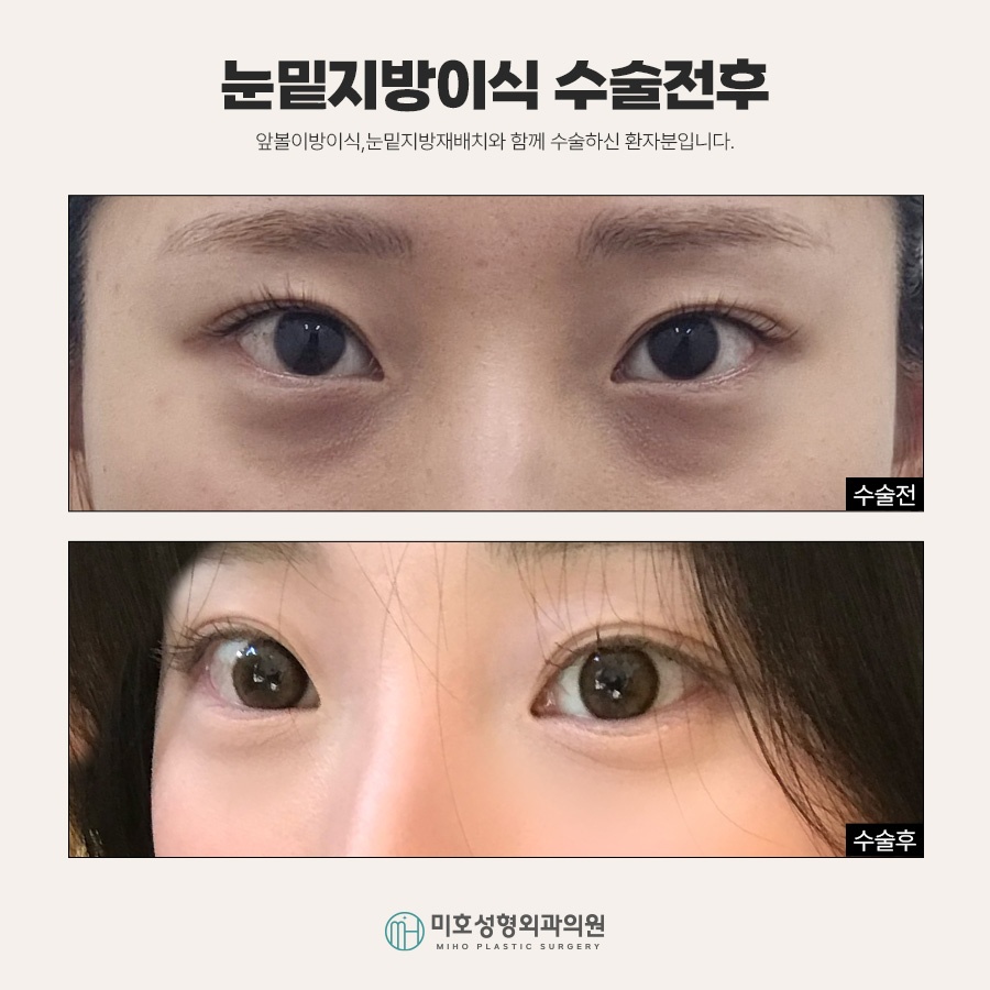 If Under-Eye Fat Grafting Is Stressful Because It Makes You Look Tired image 9