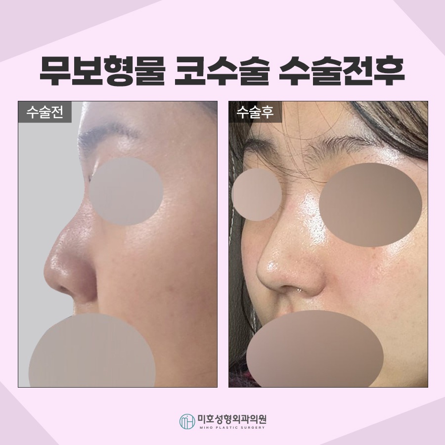 무보형물코수술 자연스러운 라인을 원한다면 관련 이미지 10