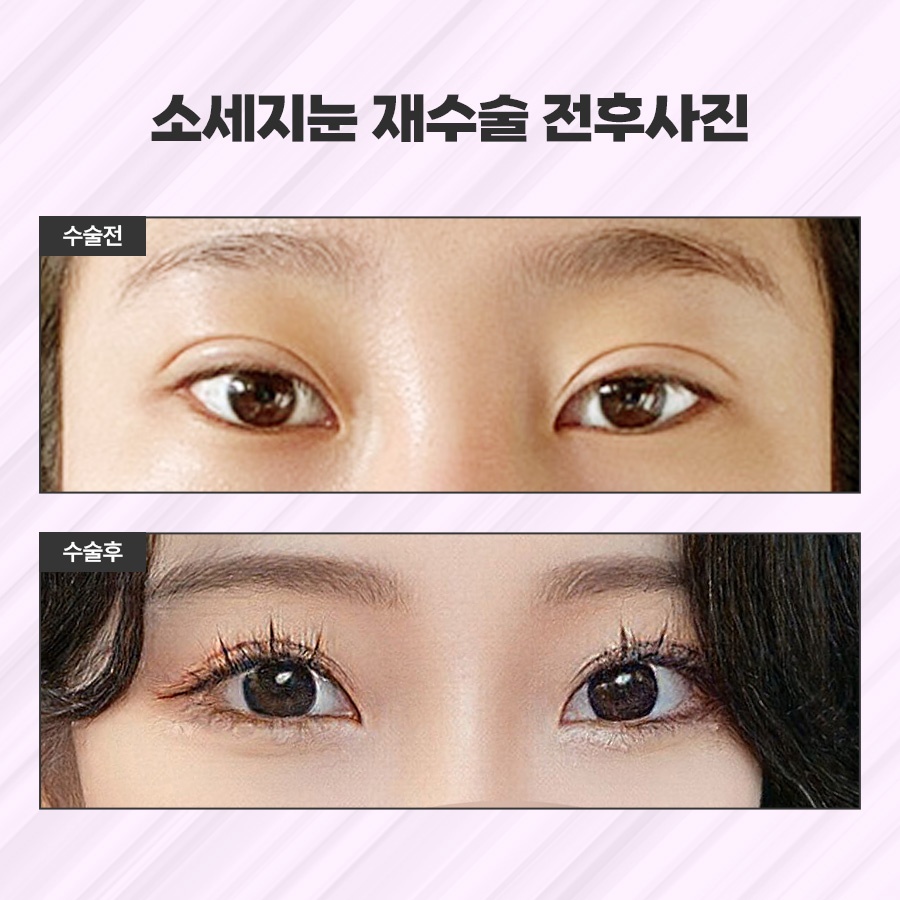 소세지눈재수술 적용 방식 2가지 관련 이미지 8