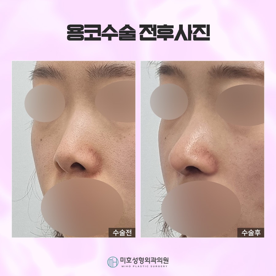 Through Drooping Nostril Correction in Bulbous Nose Surgery image 6