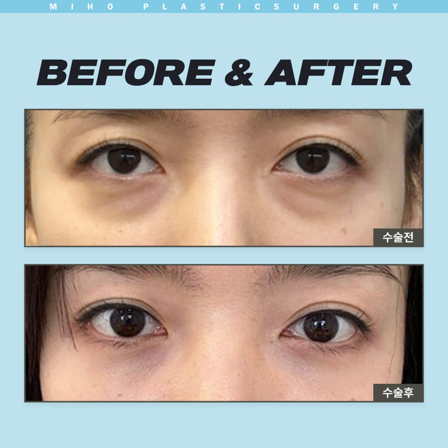 눈밑지방제거 하안검 다크써클 개선 방법 관련 이미지 6