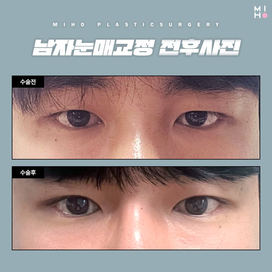 남자눈매교정 무쌍부터 유쌍까지 시원하게 관련 이미지 7