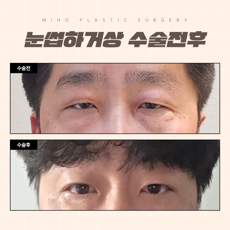 눈썹하거상 처진 눈꺼풀 또렷하게 관련 이미지 9