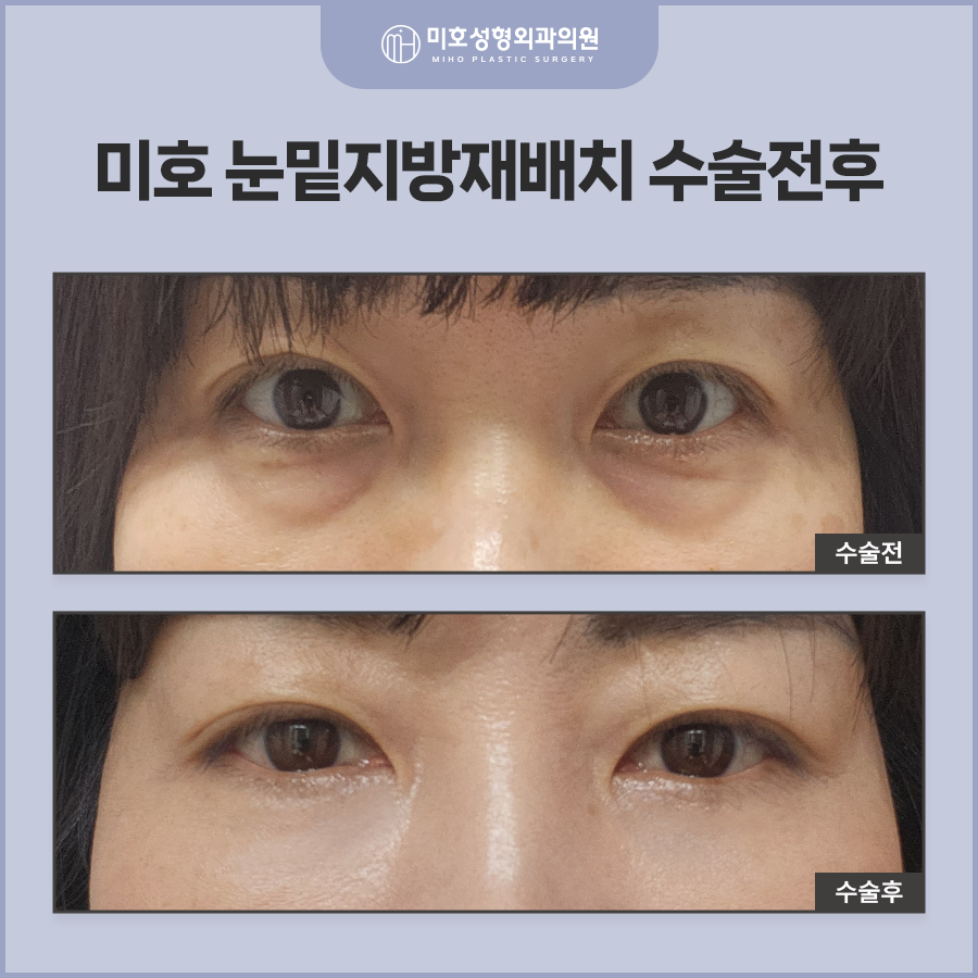 Improving Dark Circles Under the Eyes with Under-Eye Fat Repositioning to Create a More Vibrant Eye Area image 10