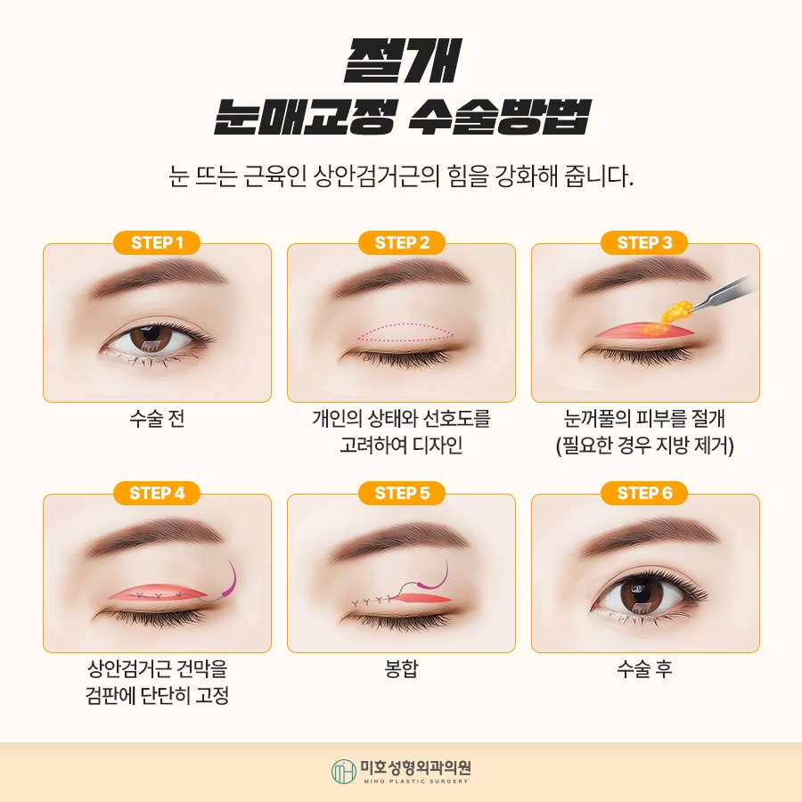 남자눈매교정 자연스러운 이미지로 관련 이미지 6