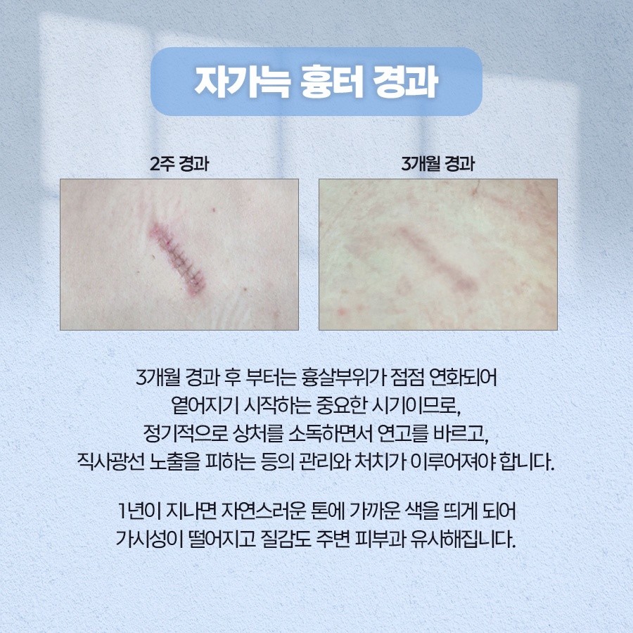 자가늑코수술 재료 특성과 회복 과정 관련 이미지 6