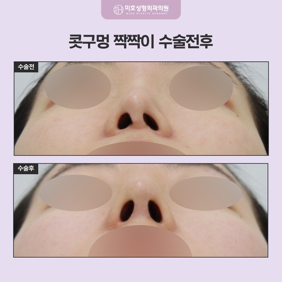 콧구멍짝짝이 원인과 교정 방향 관련 이미지 8