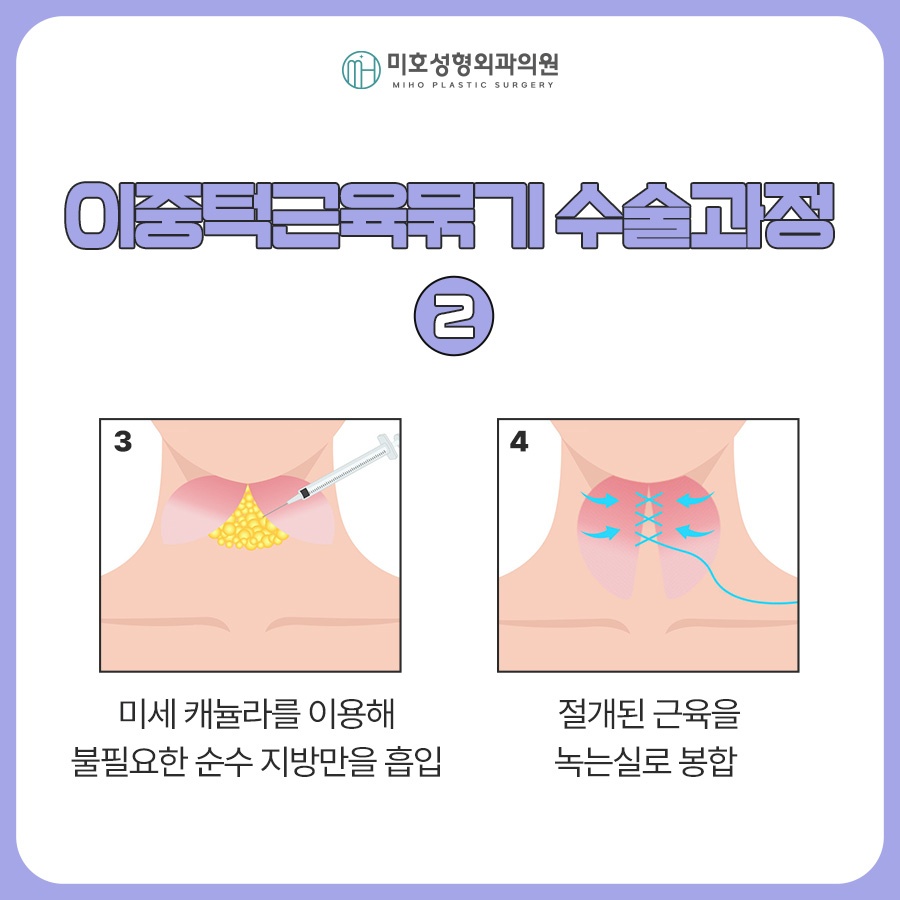 Looking at the Progress of Chin Muscle Ligation for a Double Chin image 4