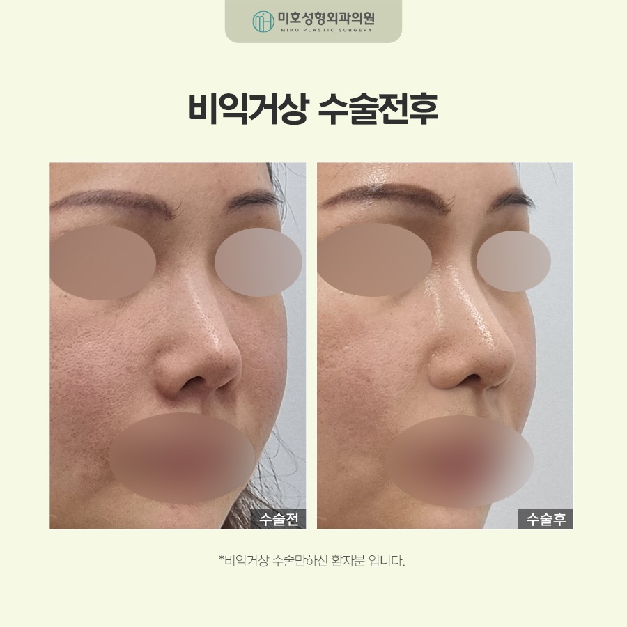 비익거상으로 예쁜 코 만드는 비결 총정리 관련 이미지 8