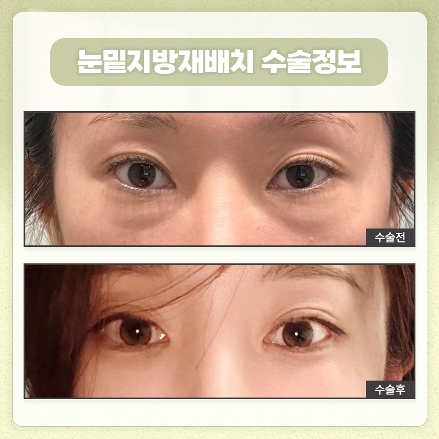 눈밑지방재배치 피로한 인상을 관련 이미지 10