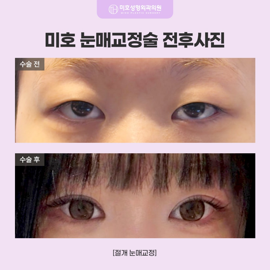 눈매교정술 힘 조절이 필요하다면 관련 이미지 9