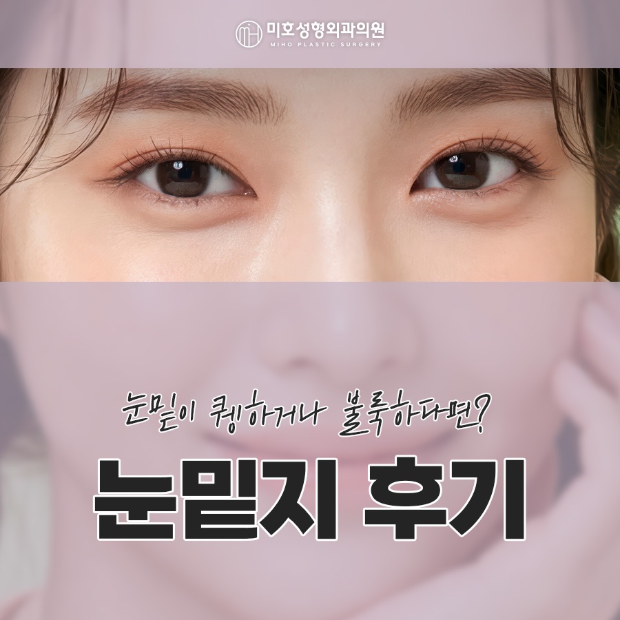 To Learn About Under-Eye Fat Graft Reviews, Methods, Swelling, and Recovery image 1