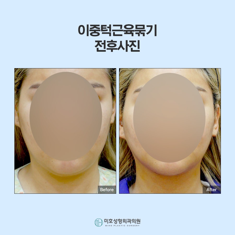 If the Jawline Beneath the Chin Looks Blurred: Double-Chin Muscle Tightening image 10